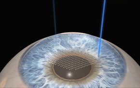 how-does-lasik-work