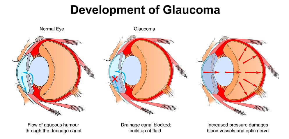 Chart Showing the Development of Glaucoma