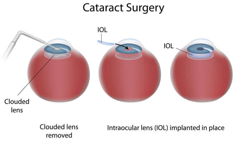 Cataract Surgery Diagram