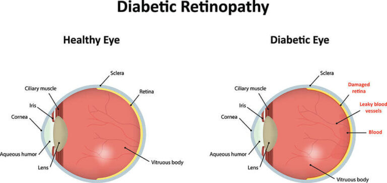 Retina Orange County | Diabetic Retinopathy Orange | Harvard Eye