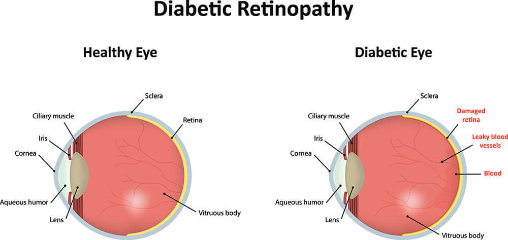 Retina Orange County | Diabetic Retinopathy Orange | Harvard Eye