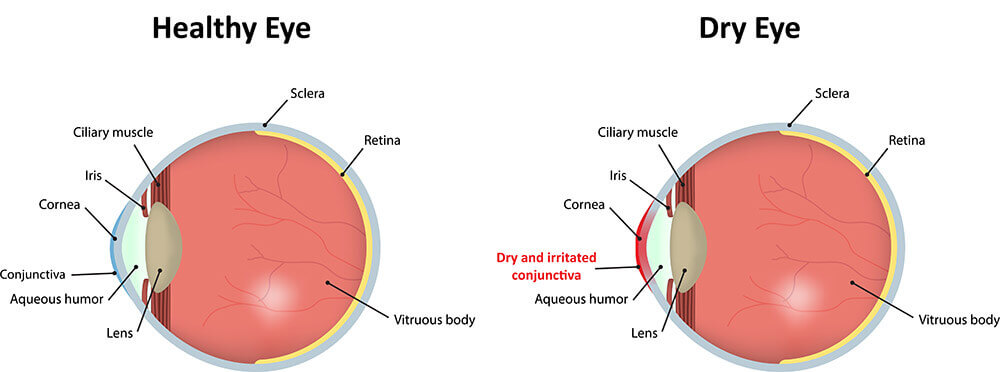 Chart Showing a Healthy Eyes Compared to Dry Eyes