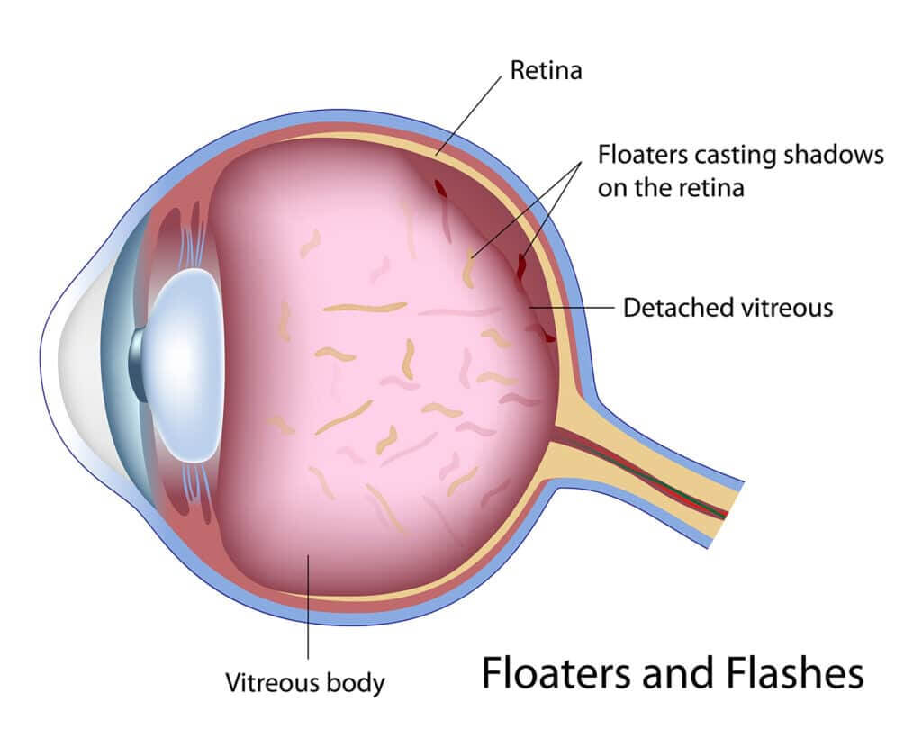 Chart illustrating how people see floaters in an eye