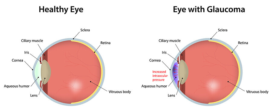 Chart Showing a Healthy Eye vs One With Glaucoma