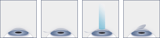 Chart Showing the Steps of the LASIK Eye Surgery Procedure