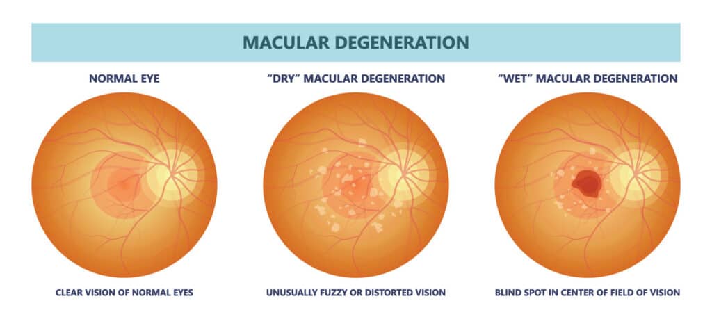 Chart illustrating a normal eye, compared to one with "Dry" Macular Degeneration and one with "Wet" Macular Degeneration