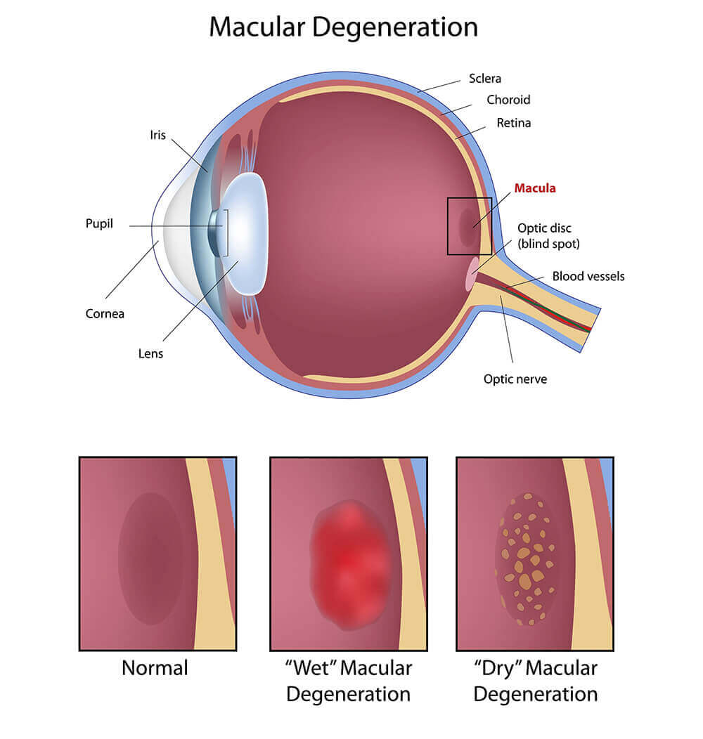 Chart Showing How Macular Degeneration Affects the Eye