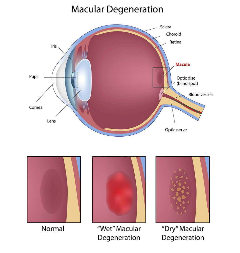 Retina Orange County | Macular Degeneration | Harvard Eye