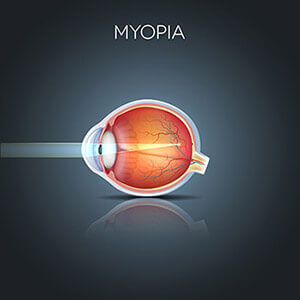 Myopia Diagram