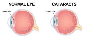 diagram of eye with and without cataracts 