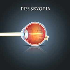 Presbyopia Diagram