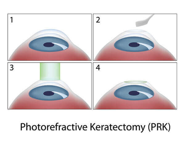 PRK Surgery Diagram
