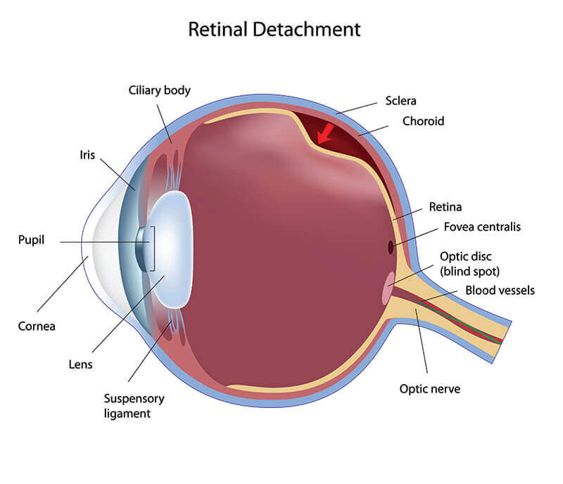 Chart Showing How a Retinal Detachment Affects the Eye