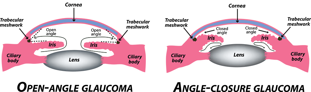 closed angle glaucoma vs open angle